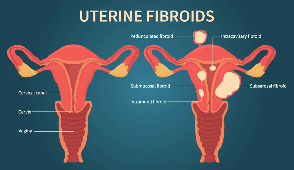Illustration of uterine fibroids, myoma, uterine leiomyomas. There are cervical canal, cervix, vagina, pedunculated, intracavitary, submucosal, subserosal fibroid.