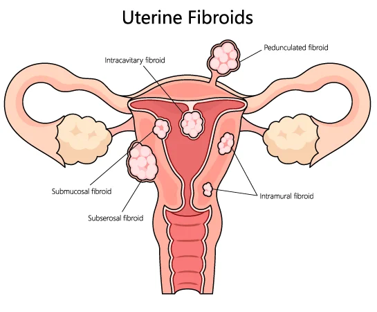 Various types of uterine fibroids, including submucosal, subserosal, and intramural fibroids structure diagram.