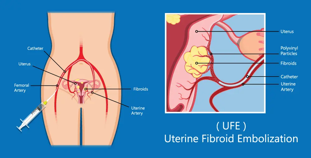 Medical illustration showing Uterine Fibroid Embolization (UFE) with a catheter inserted in the femoral artery to the uterine artery, delivering particles to block blood flow to fibroids in the uterus.