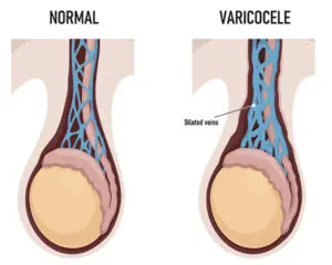 diagram showing normal vs Varicocele (dilated veins)