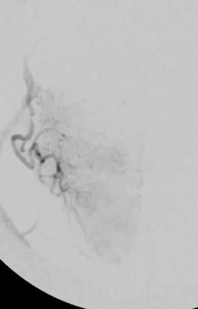 looking at right lobe prostate veins through microscope