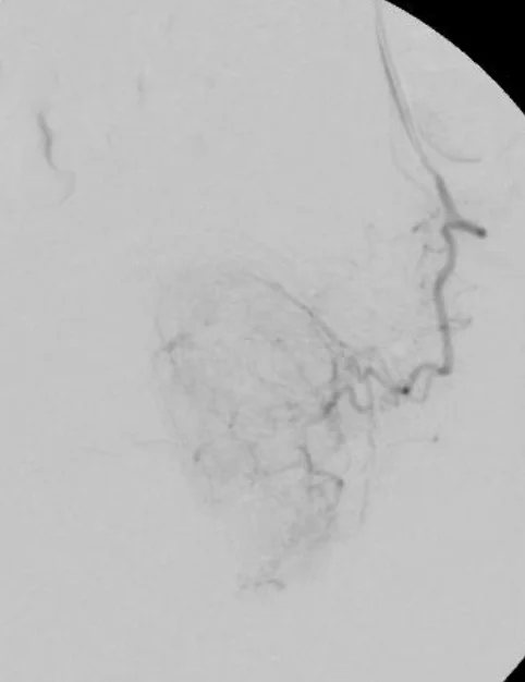looking at prostate veins through microscope