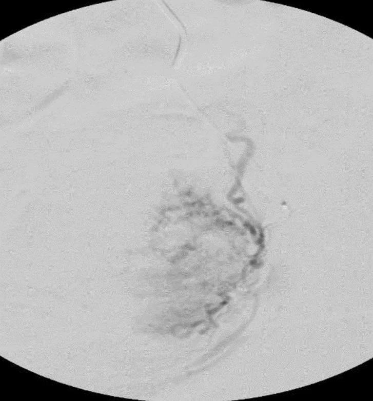 looking at Uterine fibroid left through microscope